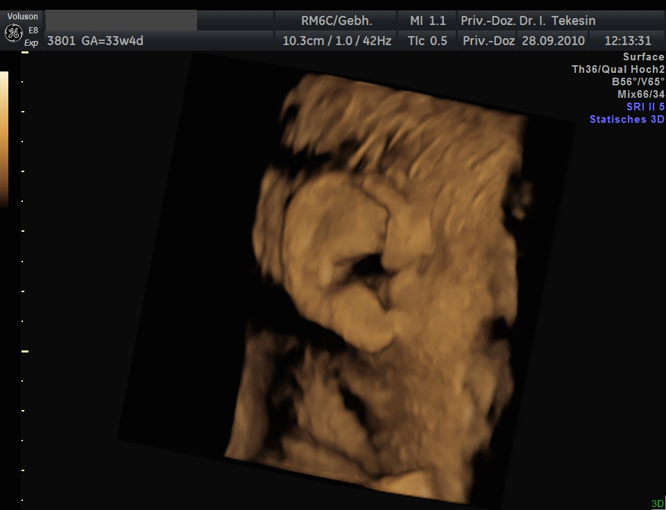 37 Best Photos Baby Ultrasound With Hair : 3d Ultrasound In Boston 4d Ultrasound Hd Ultrasound In Boston